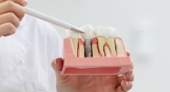 Implanty zębowe w Krakowie - nowoczesne rozwiązanie dla utraconego uśmiechu
