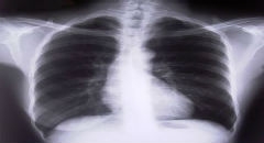 Eksperci: rak płuca to kilkadziesiąt r&oacute;żnych nowotwor&oacute;w